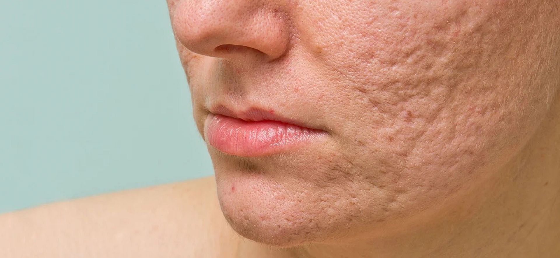 blizny potrądzikowe